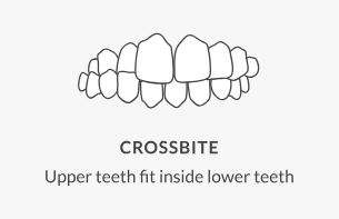 Crossed Bites